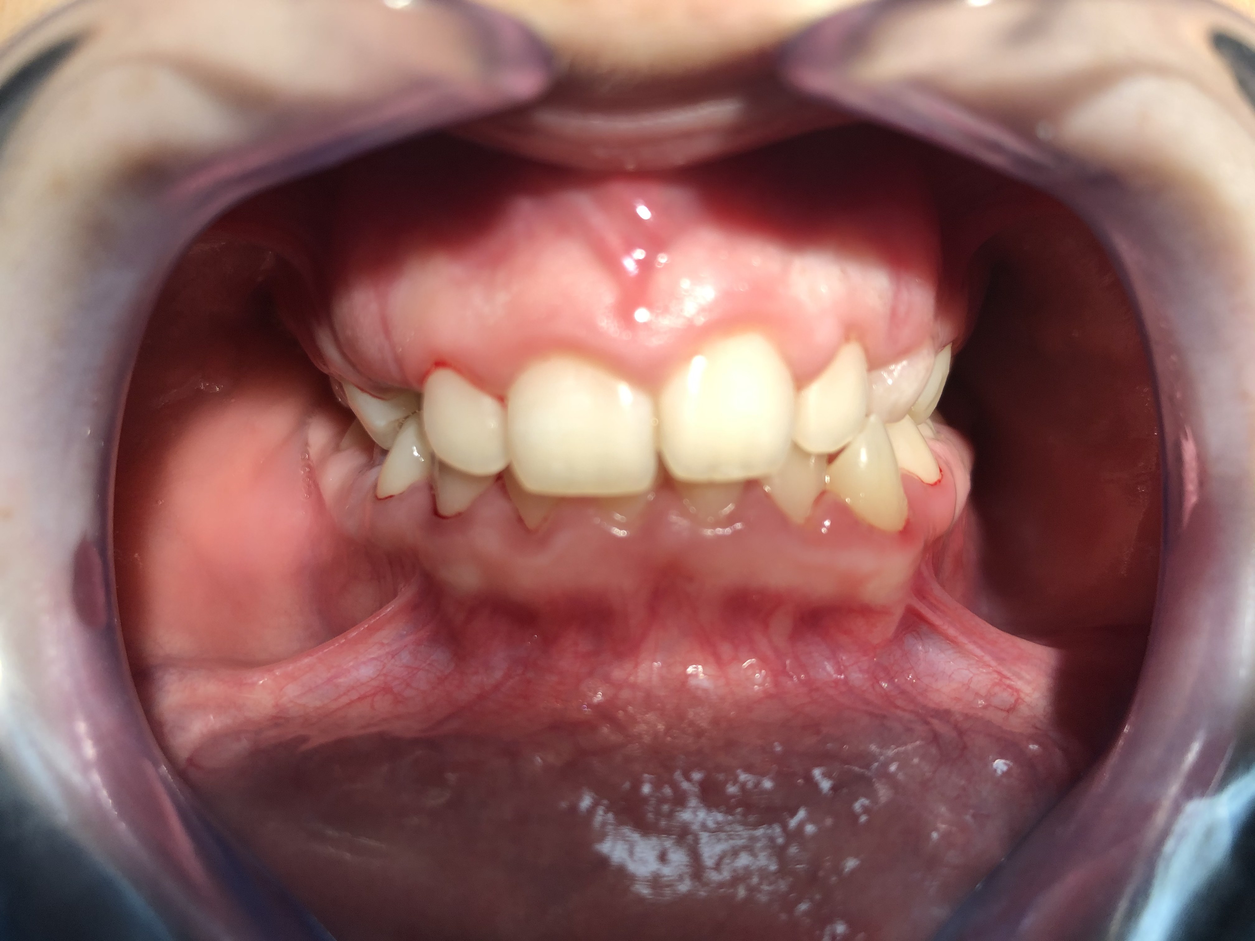 Dents apinyades abans del tractament d'ortodòncia a la clínica dental de Sants