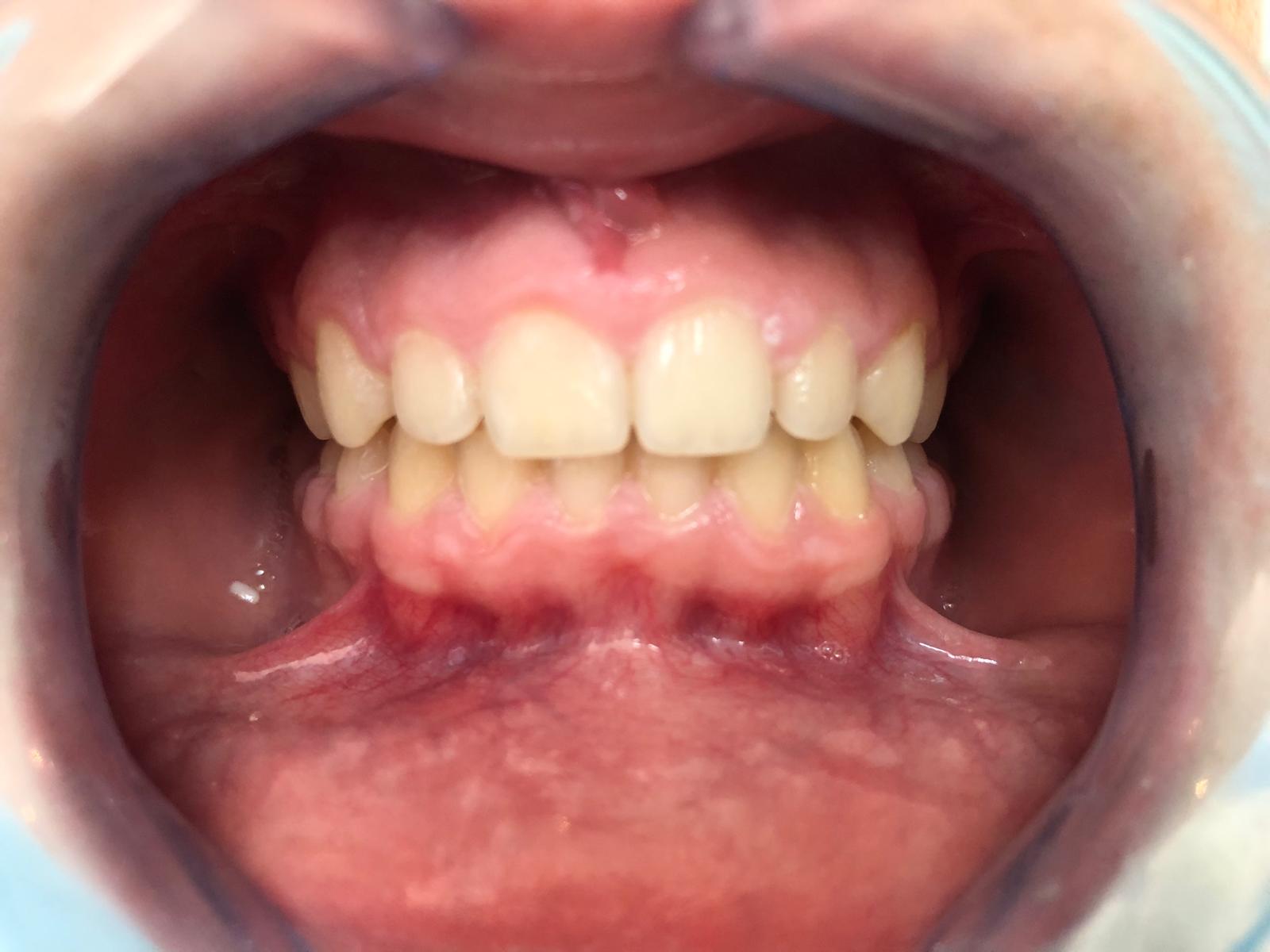 Dents alineades després del tractament d'ortodòncia a la clínica dental de Sants